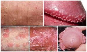 ngứa dương vật