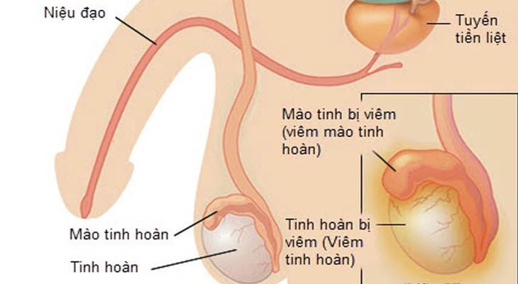 Viêm tinh hoàn