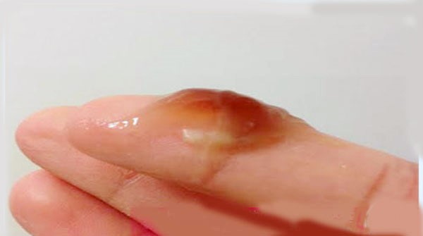 Khí hư màu nâu: cảnh báo viêm cổ tử cung, ung thư cổ tử cung