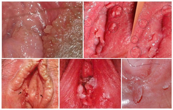 Phát hiện sùi mào gà do âm đạo nổi mụn