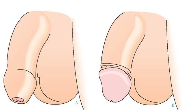 Cắt Bao Quy Đầu Là Gì?
