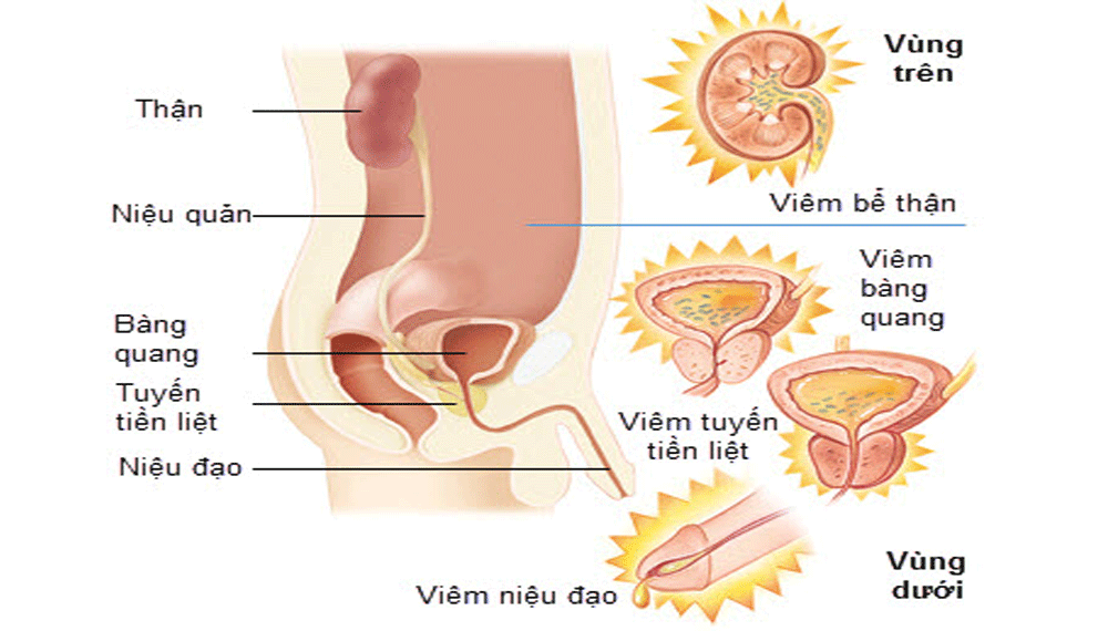 Bệnh viêm đường tiết niệu và những hệ quả