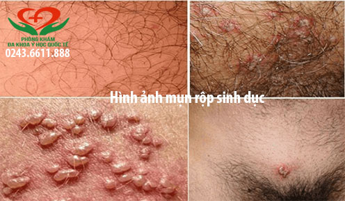 Dương vật nổi mụn là bệnh gì?