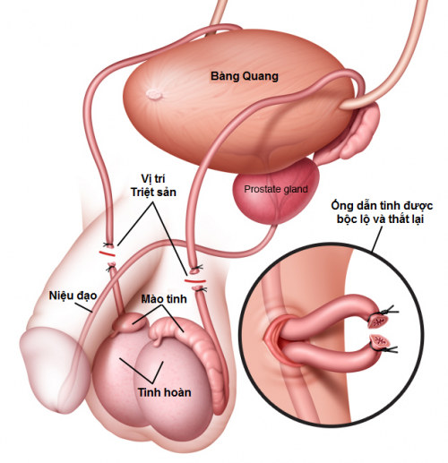 Tìm Hiểu về Kĩ Thuật Triệt Sản ở Nam Giới