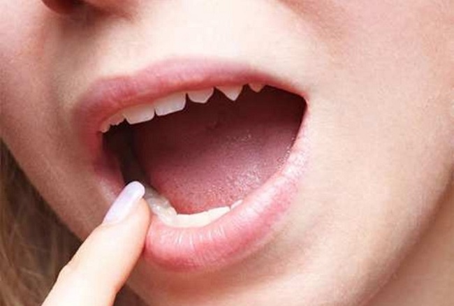 Quan Hệ Bằng Miệng Có Bị Lây Sùi Mào Gà