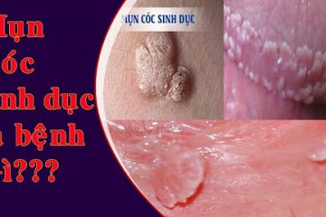 Mụn cóc sinh dục có nguy hiểm không?