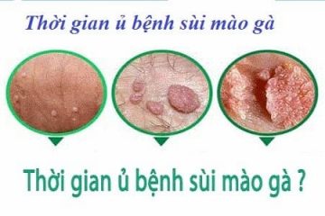 Thời gian ủ bệnh sùi mào gà trong bao lâu?